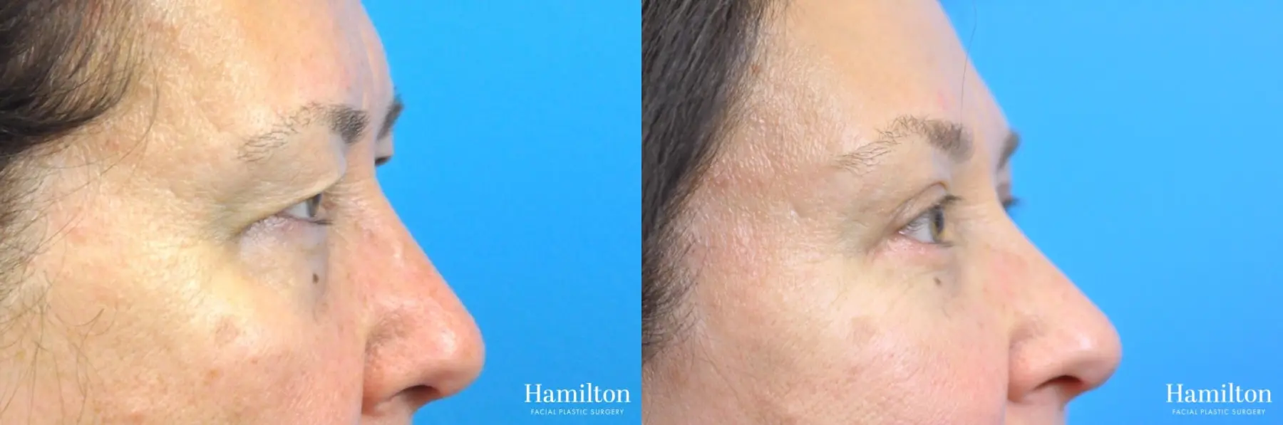 Blepharoplasty: Patient 21 - Before and After 3