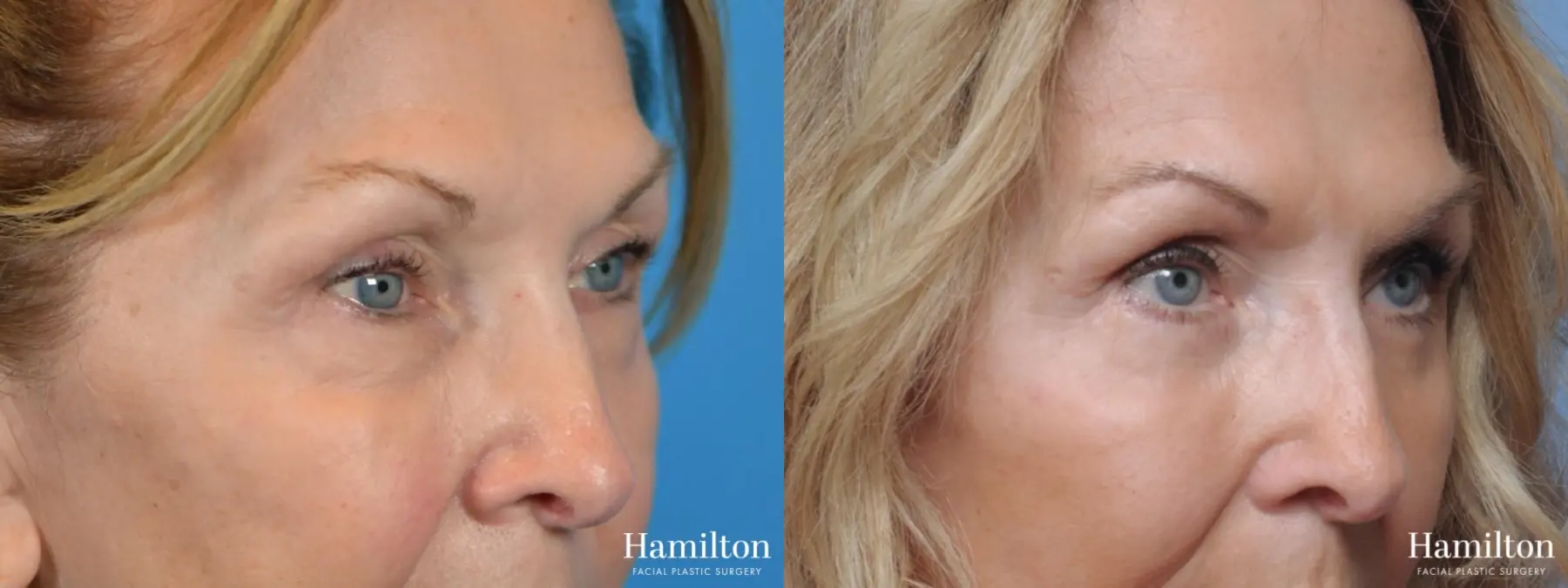 Blepharoplasty: Patient 1 - Before and After 3