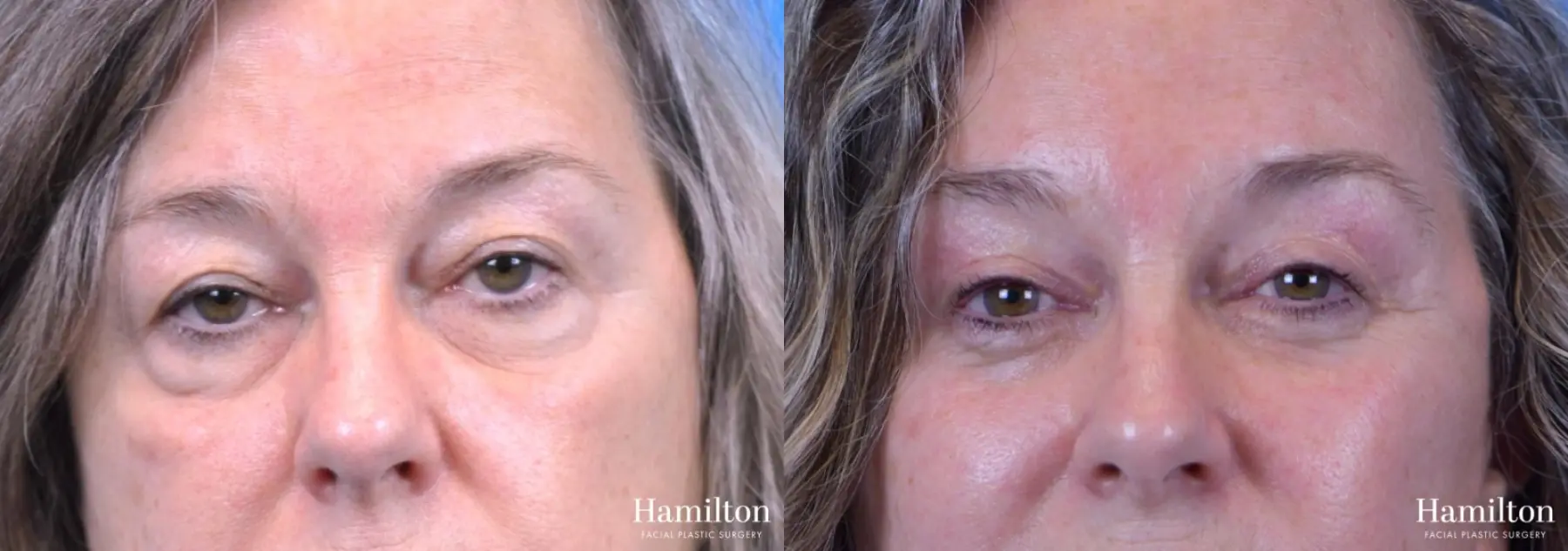 Blepharoplasty: Patient 14 - Before and After 1