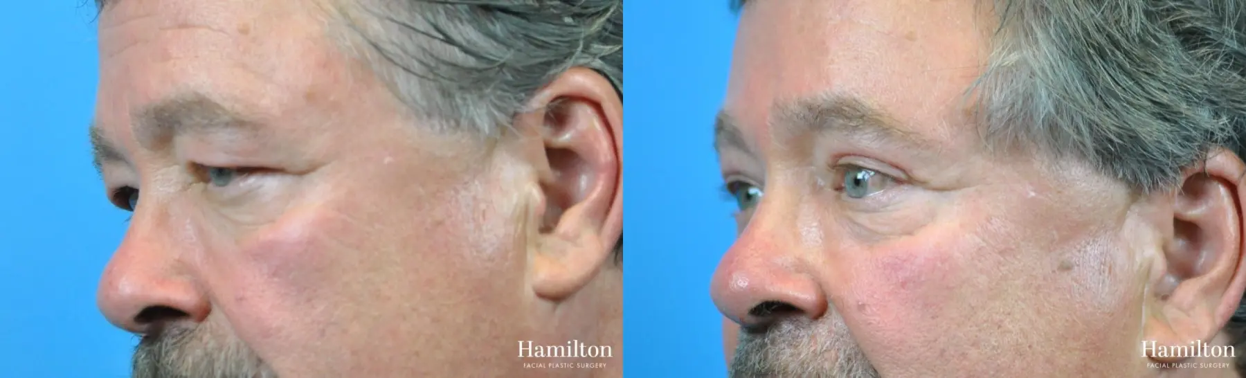 Blepharoplasty: Patient 19 - Before and After 2