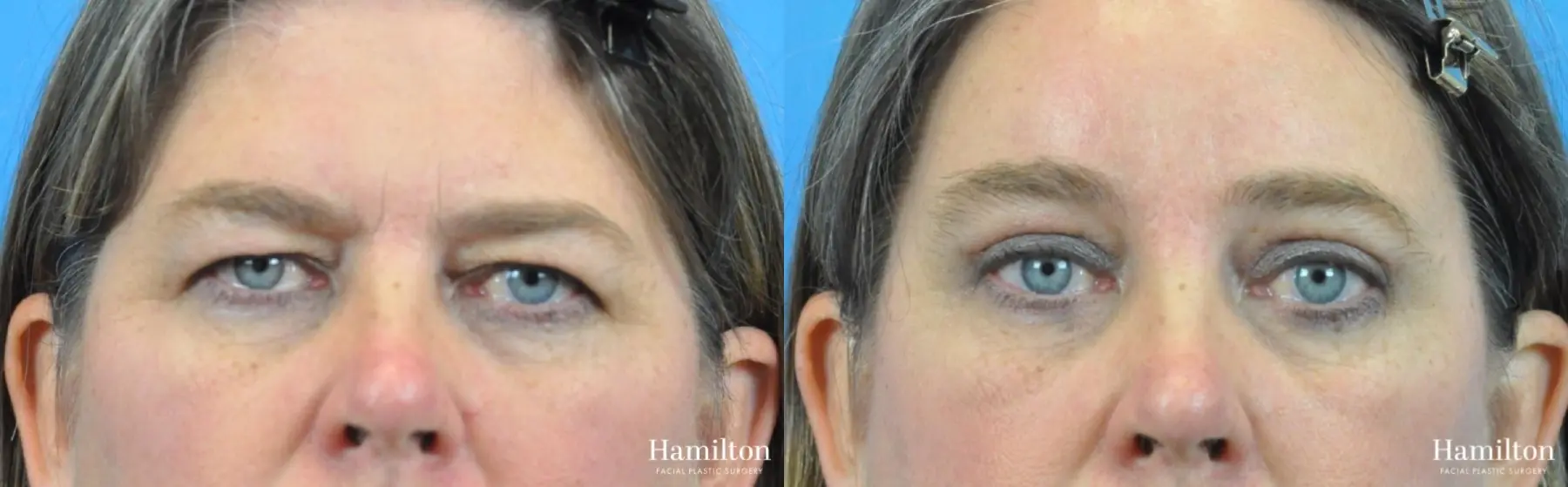 Blepharoplasty: Patient 16 - Before and After 1