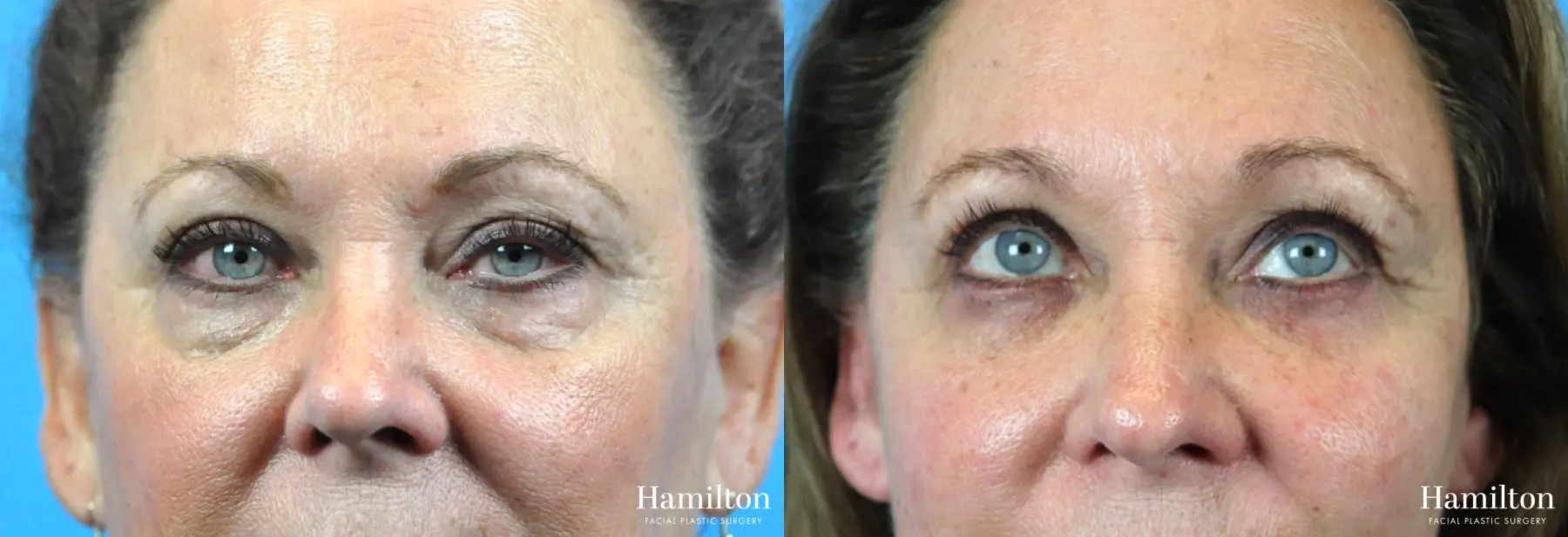 Blepharoplasty: Patient 27 - Before and After 3