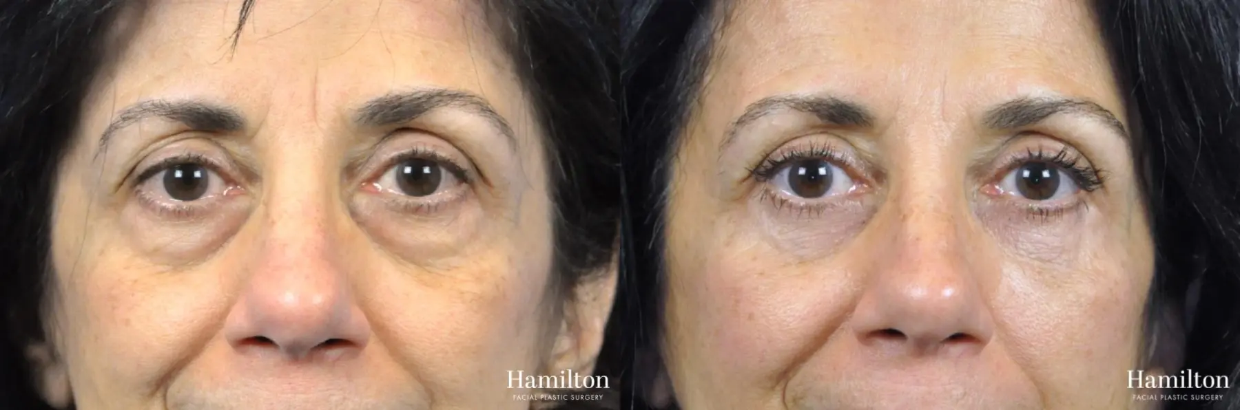 Blepharoplasty: Patient 10 - Before and After 3