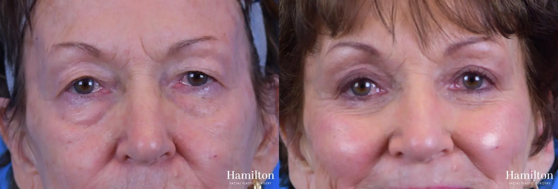 Blepharoplasty: Patient 13 - Before and After 1