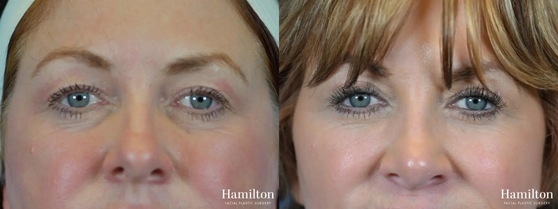 Blepharoplasty: Patient 9 - Before and After 3