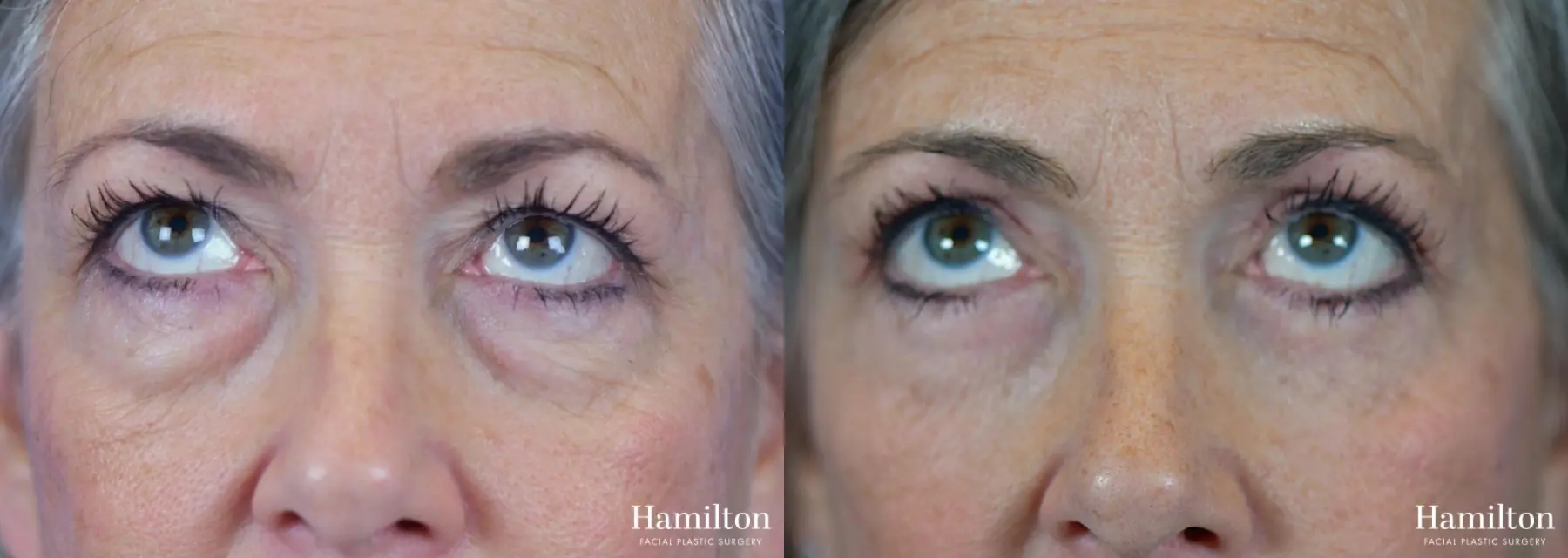 Blepharoplasty: Patient 12 - Before and After 2