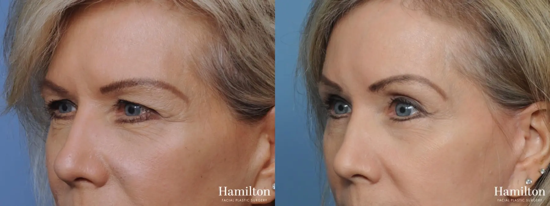 Blepharoplasty: Patient 5 - Before and After 2