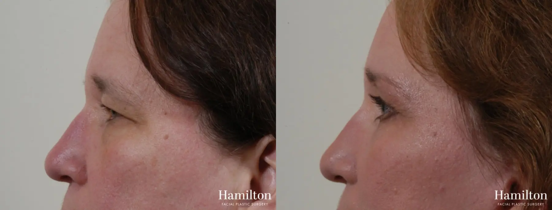 Blepharoplasty: Patient 7 - Before and After 3