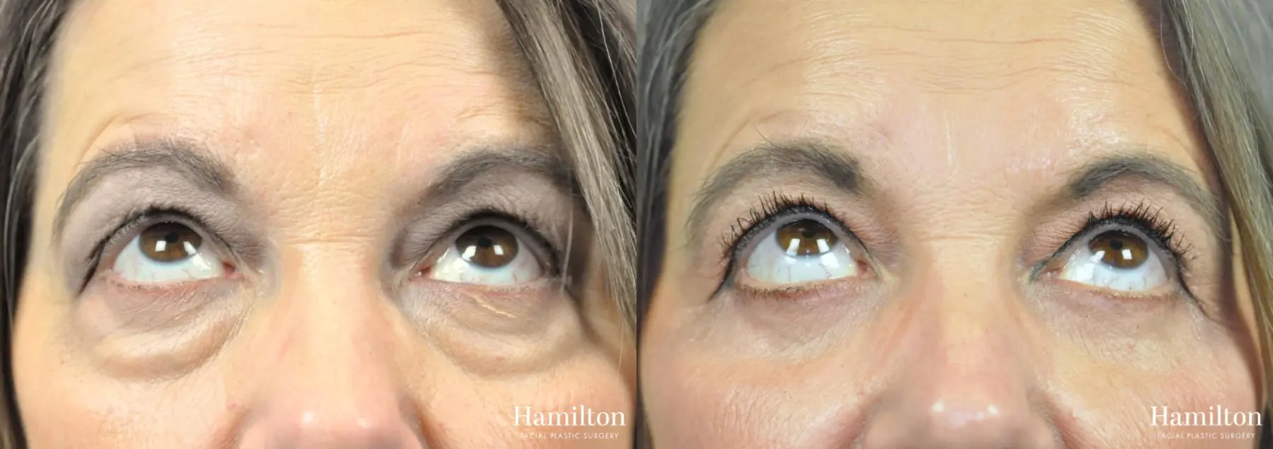 Blepharoplasty: Patient 3 - Before and After  