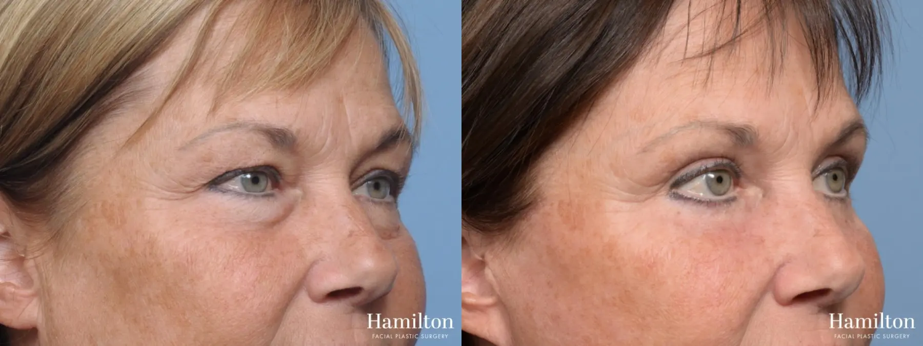 Blepharoplasty: Patient 2 - Before and After 3