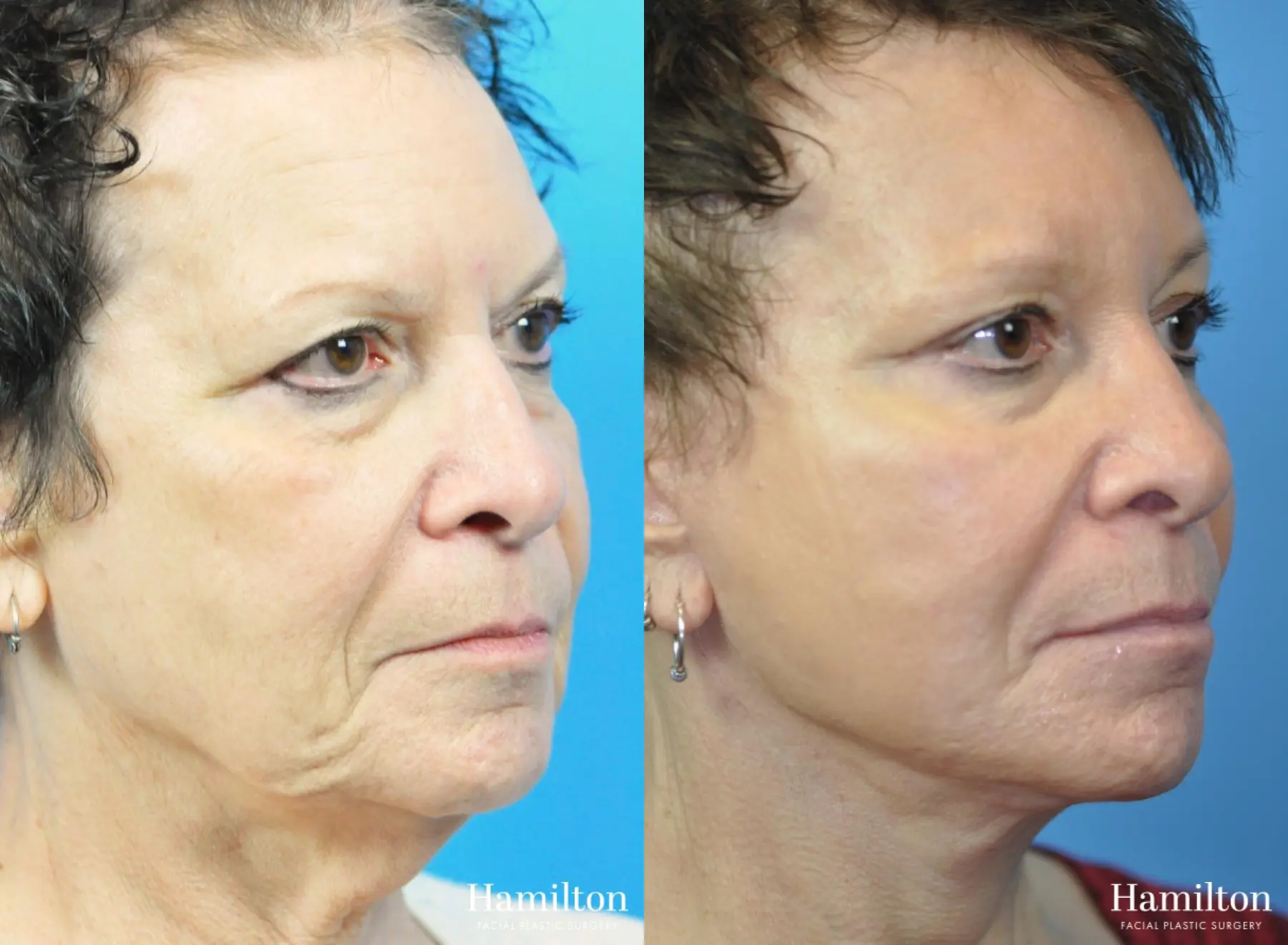 Brow Lift: Patient 10 - Before and After 2