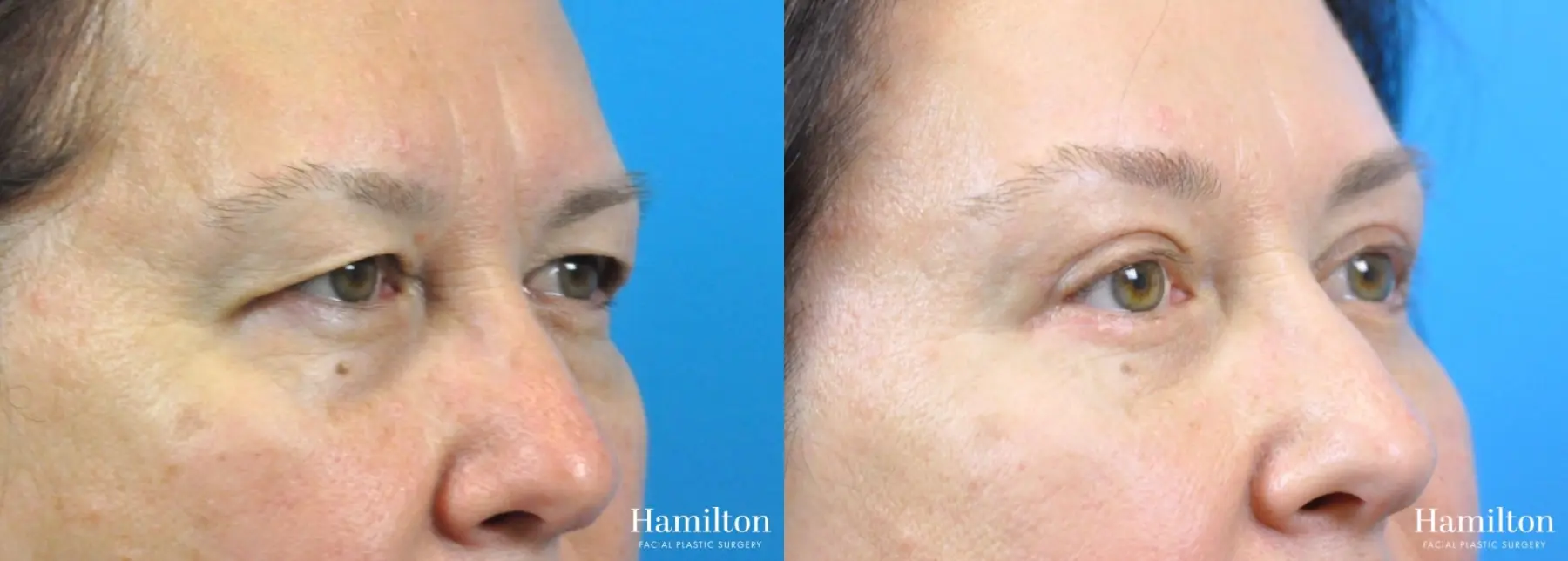 Brow Lift Before & After Gallery: Patient 5