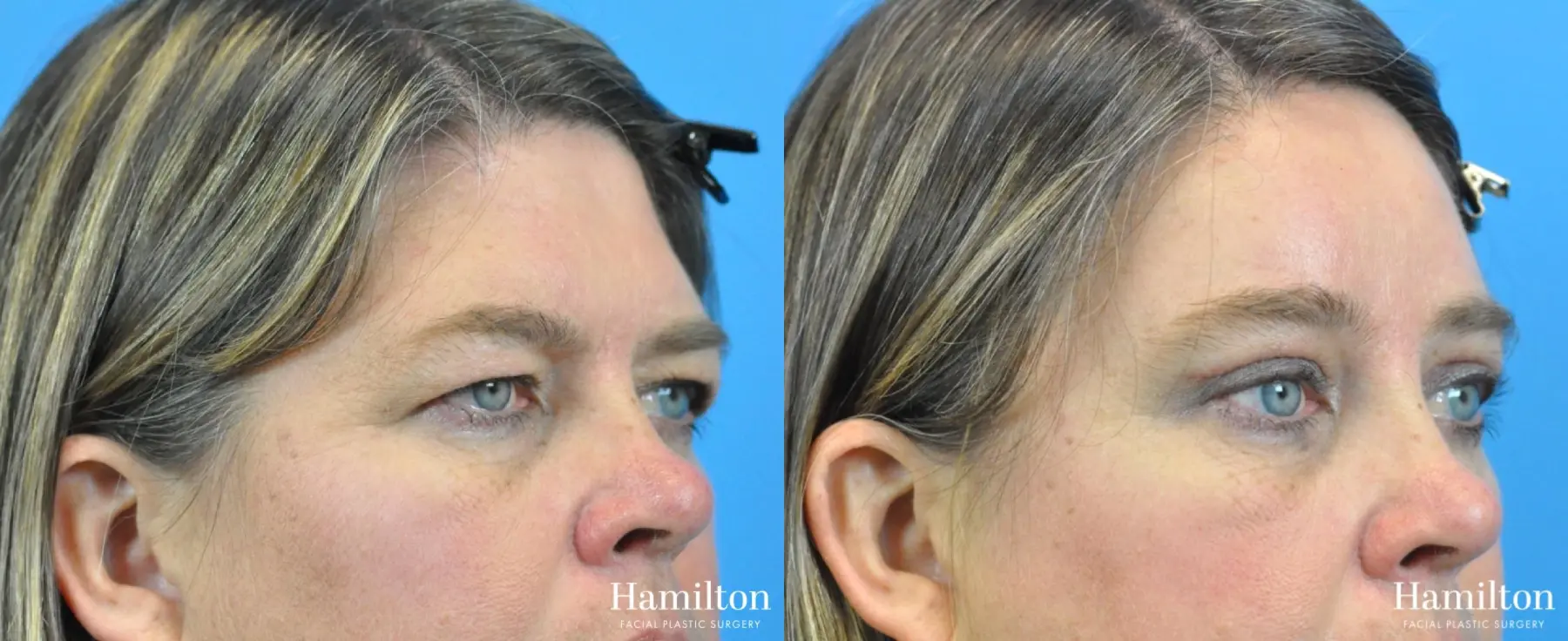 Brow Lift: Patient 4 - Before and After 3