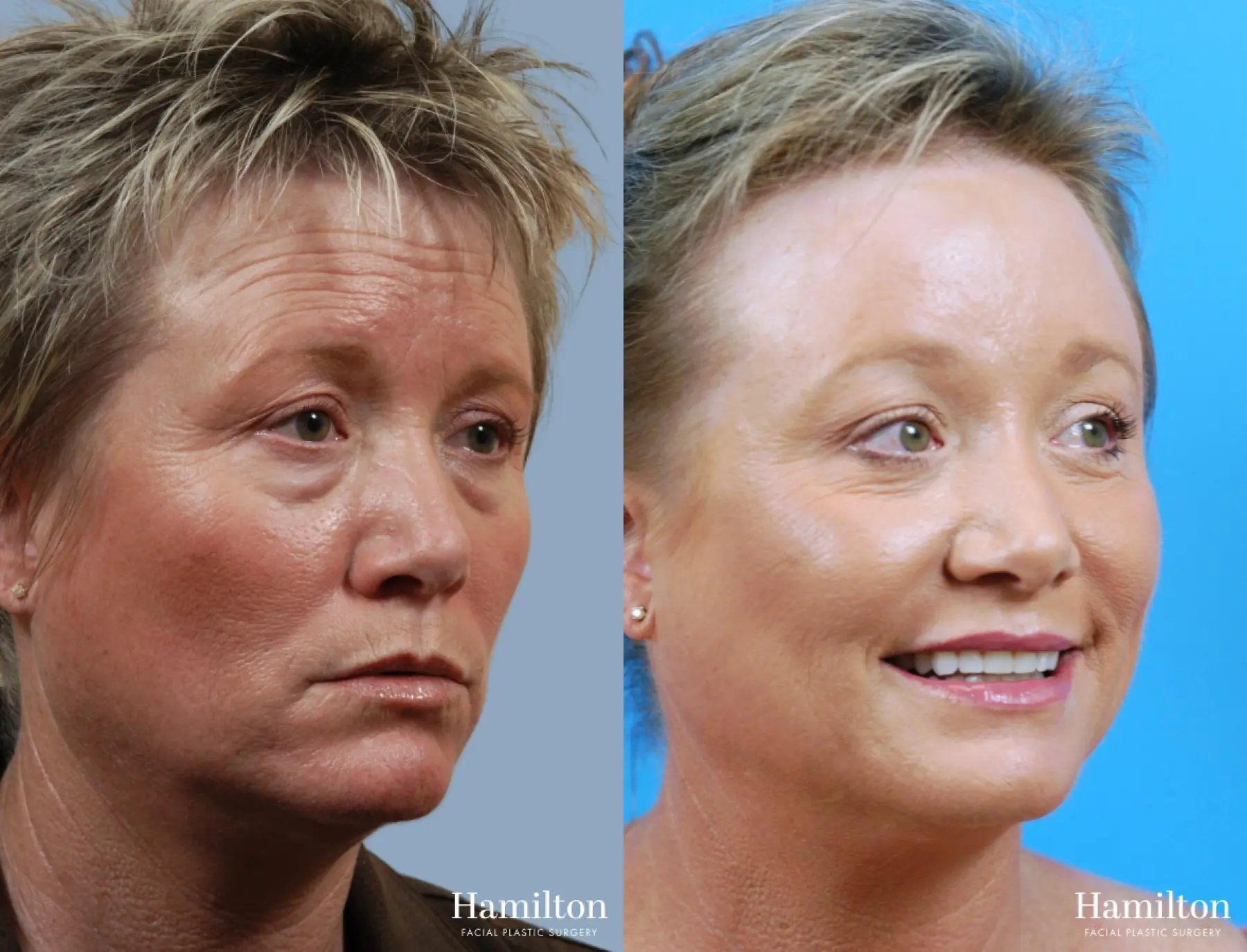 Brow Lift: Patient 9 - Before and After 3