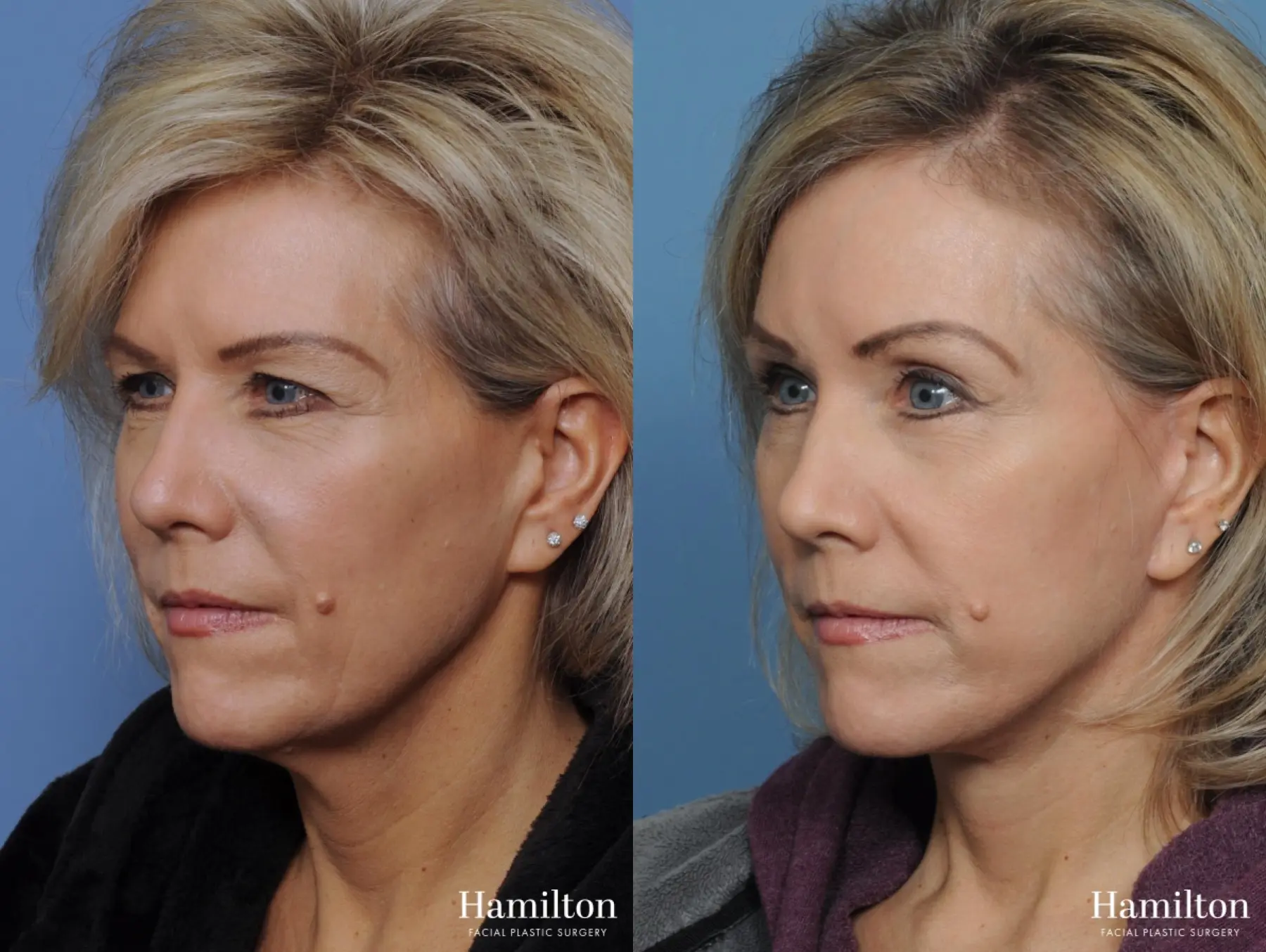 Brow Lift: Patient 3 - Before and After 5