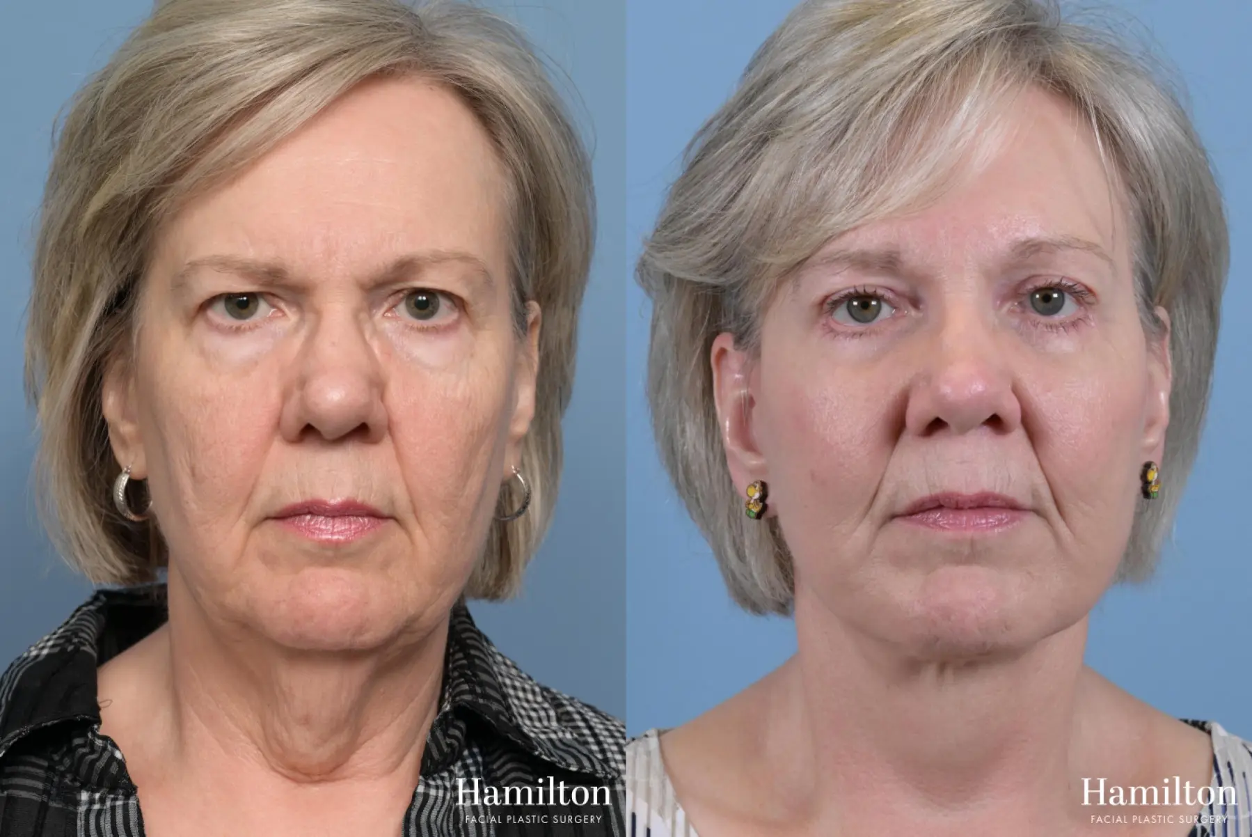 Brow Lift: Patient 9 - Before and After 5