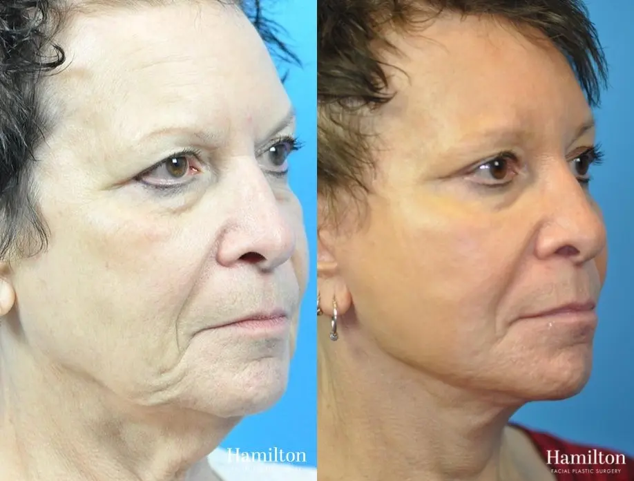 Brow Lift: Patient 7 - Before and After 2