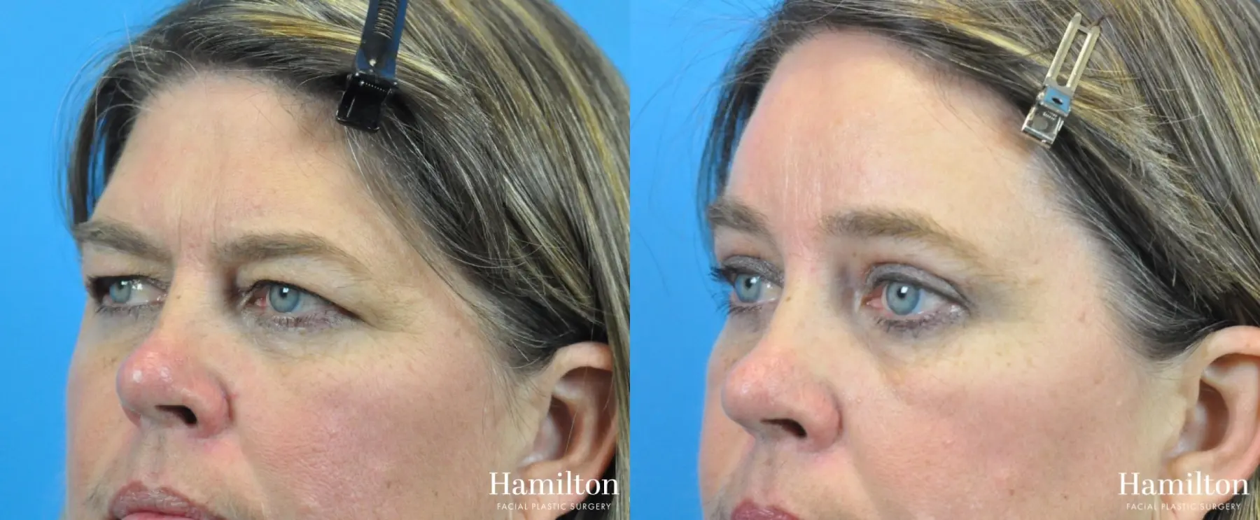 Brow Lift: Patient 4 - Before and After 2