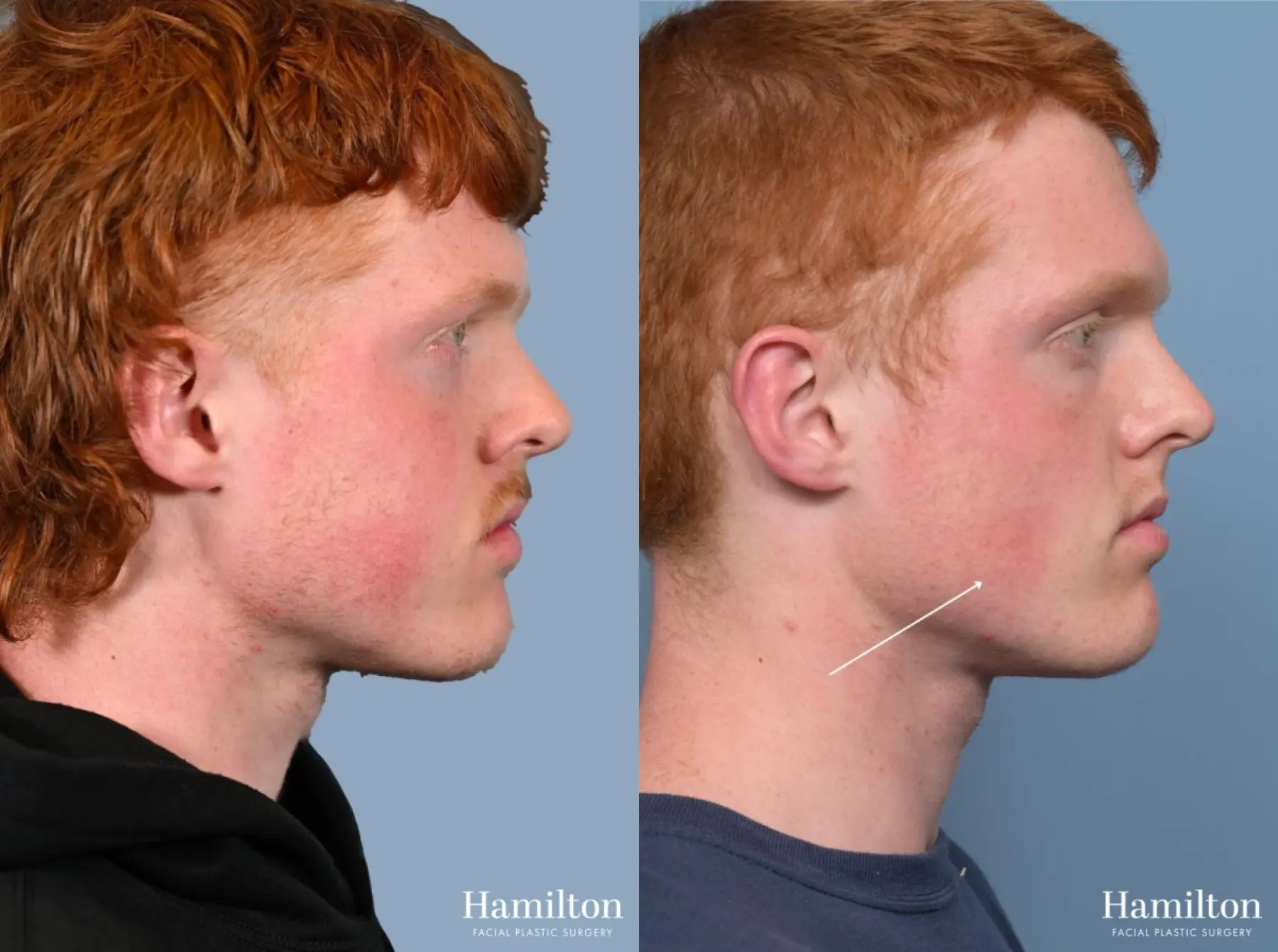 Buccal Fat Removal: Patient 1 - Before and After 2