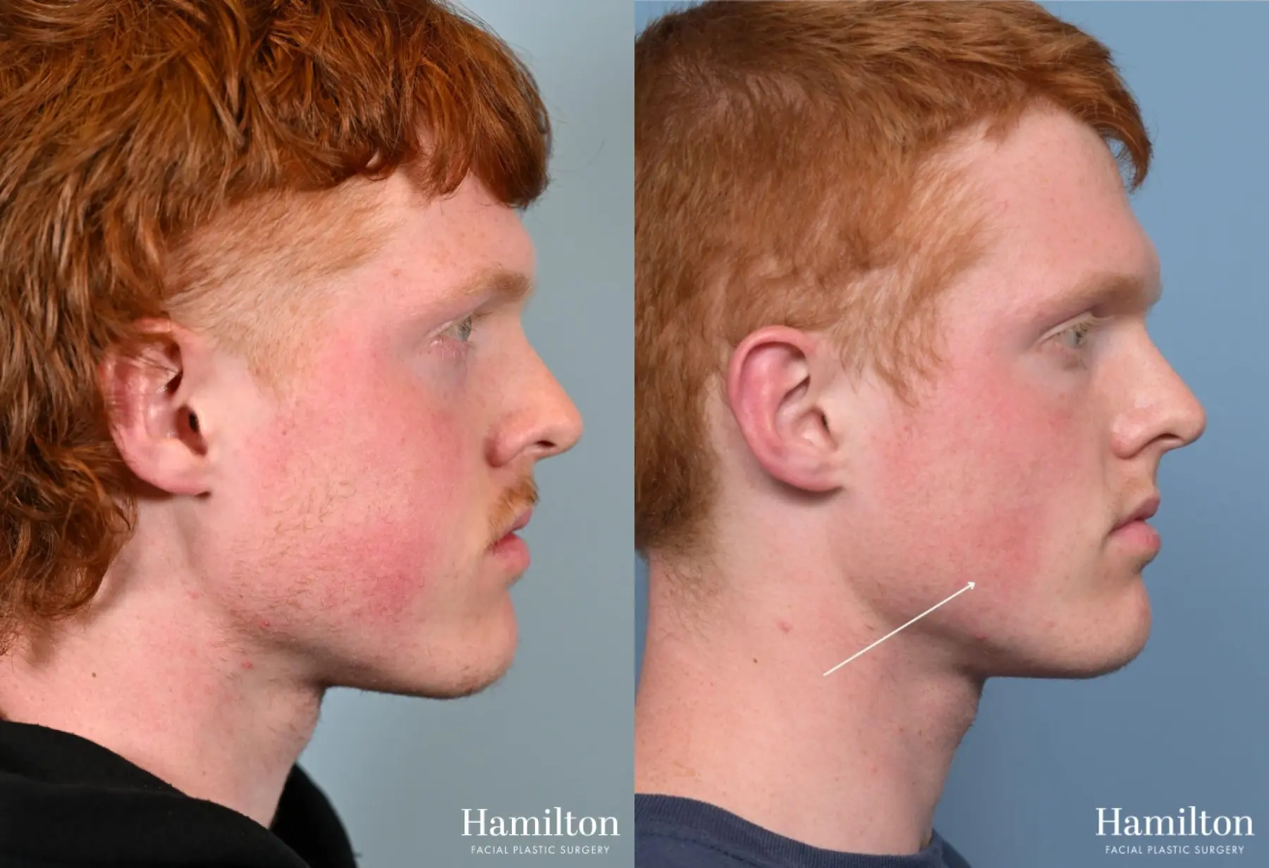 Buccal Fat Removal: Patient 1 - Before and After 2