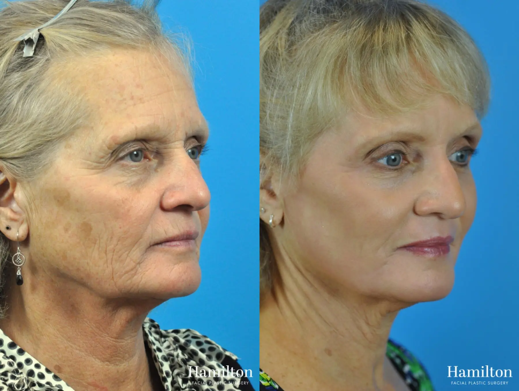 C02 Laser: Patient 1 - Before and After 5