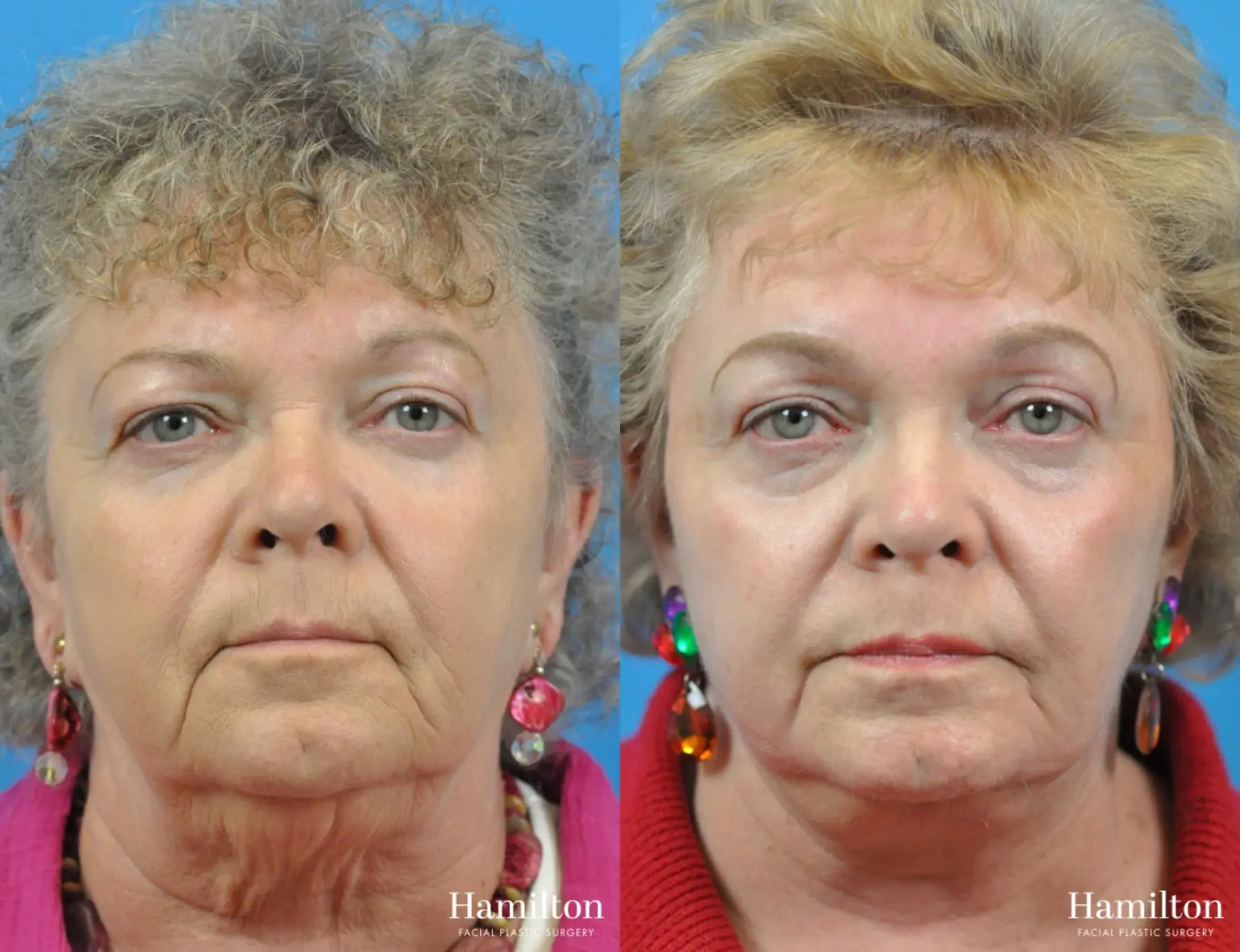 C02 Laser: Patient 10 - Before and After 1