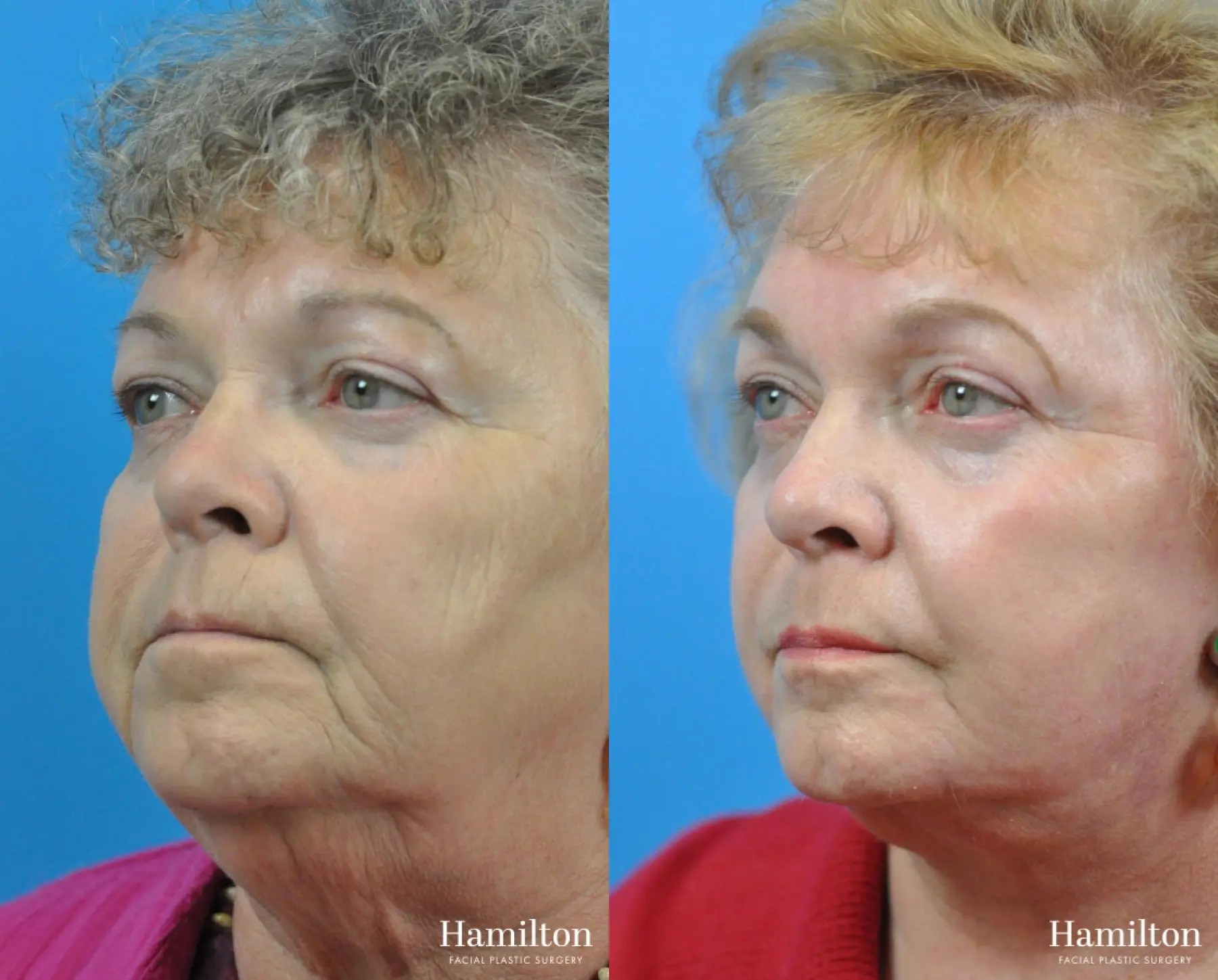 C02 Laser: Patient 10 - Before and After 3