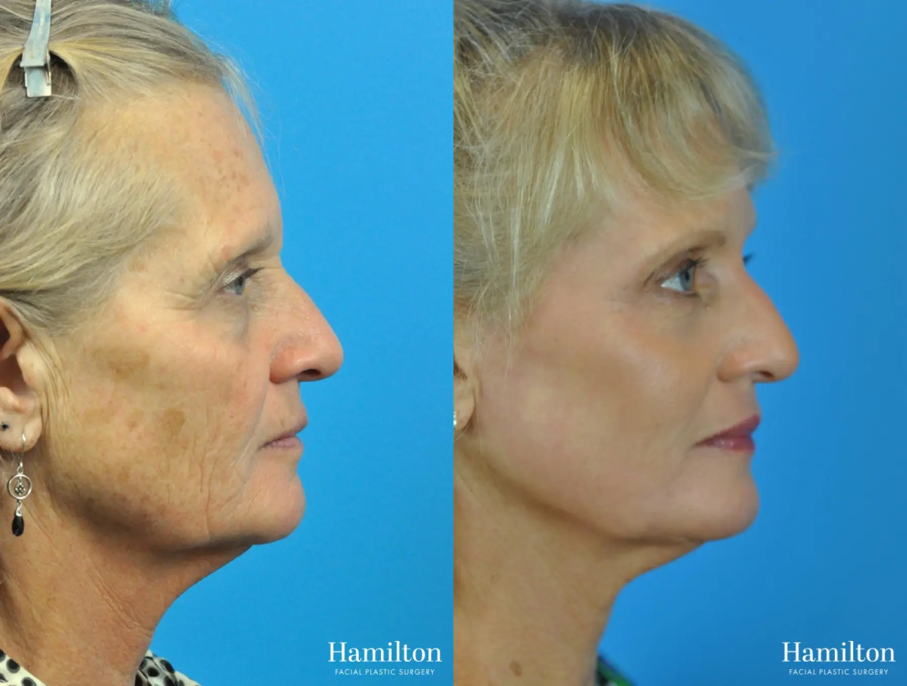 C02 Laser: Patient 1 - Before and After 4