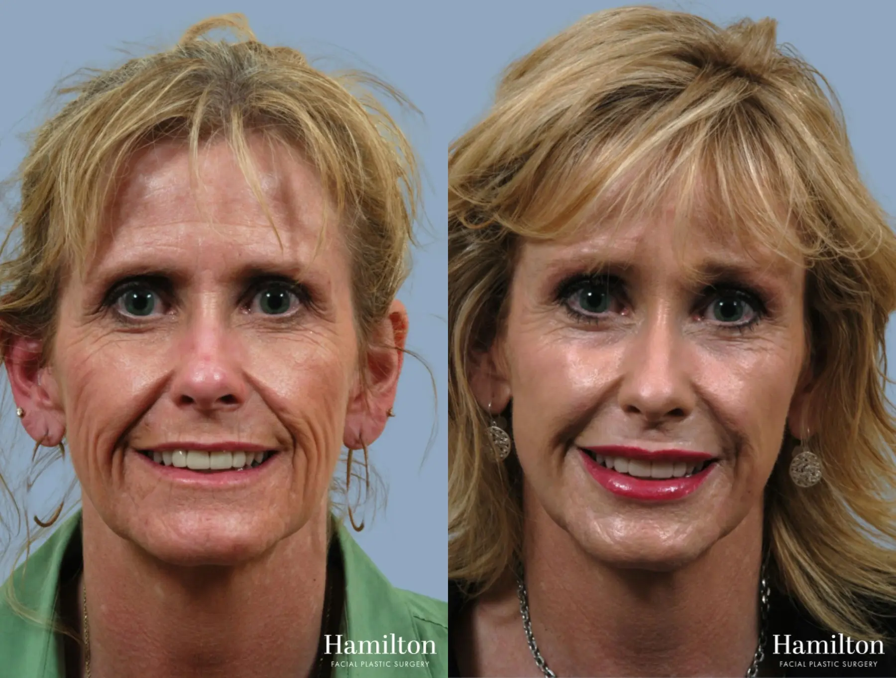 C02 Laser: Patient 9 - Before and After 1