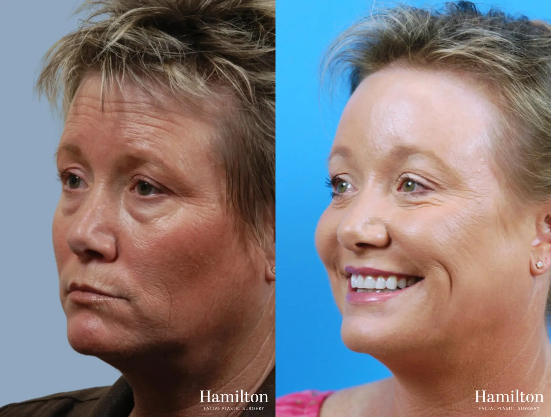 C02 Laser: Patient 8 - Before and After 2