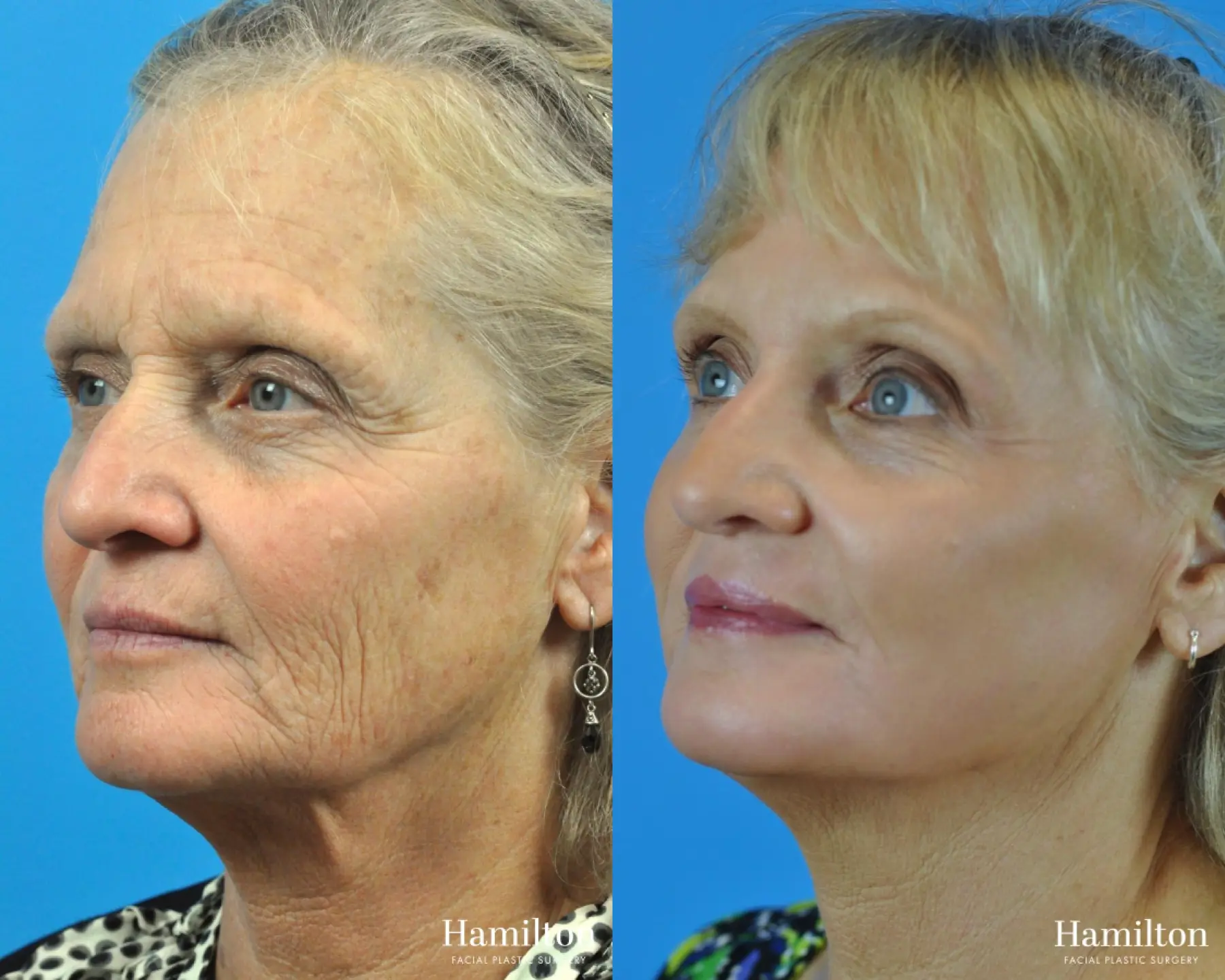 C02 Laser: Patient 1 - Before and After 2