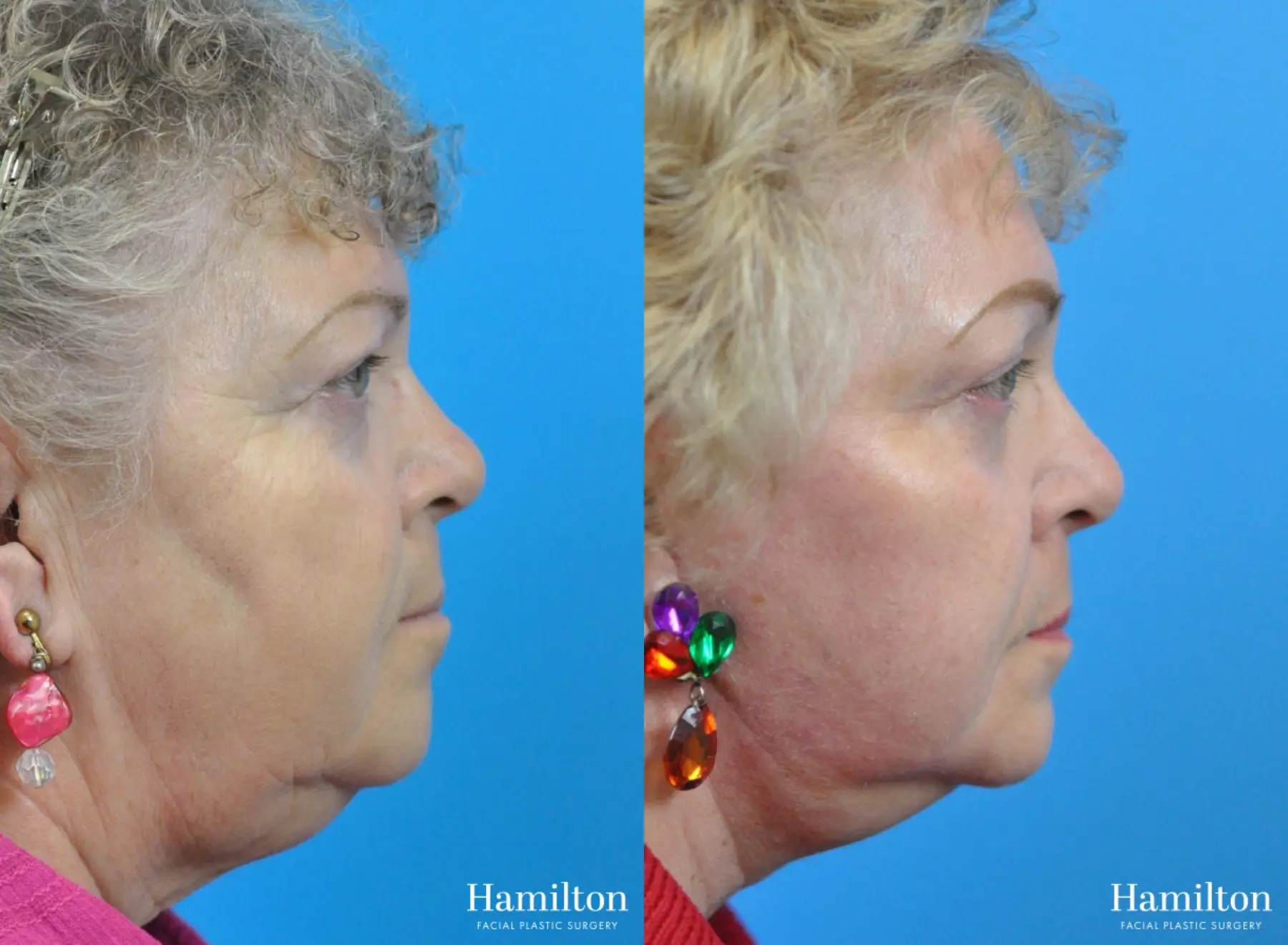 C02 Laser: Patient 10 - Before and After 4