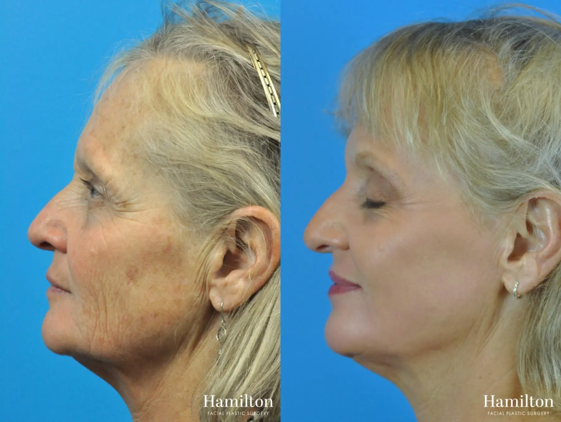 C02 Laser: Patient 1 - Before and After 3