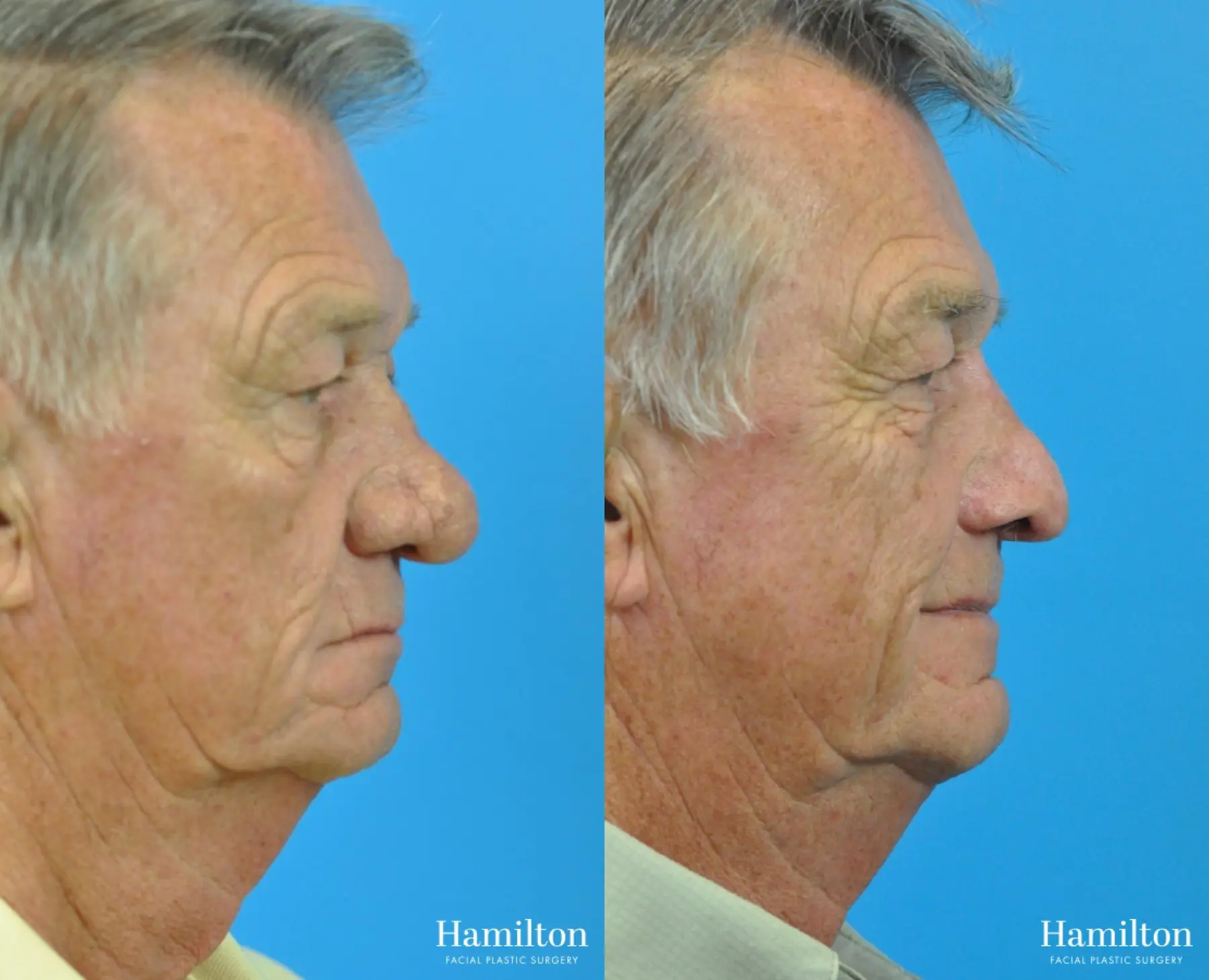 C02 Laser: Patient 11 - Before and After 2