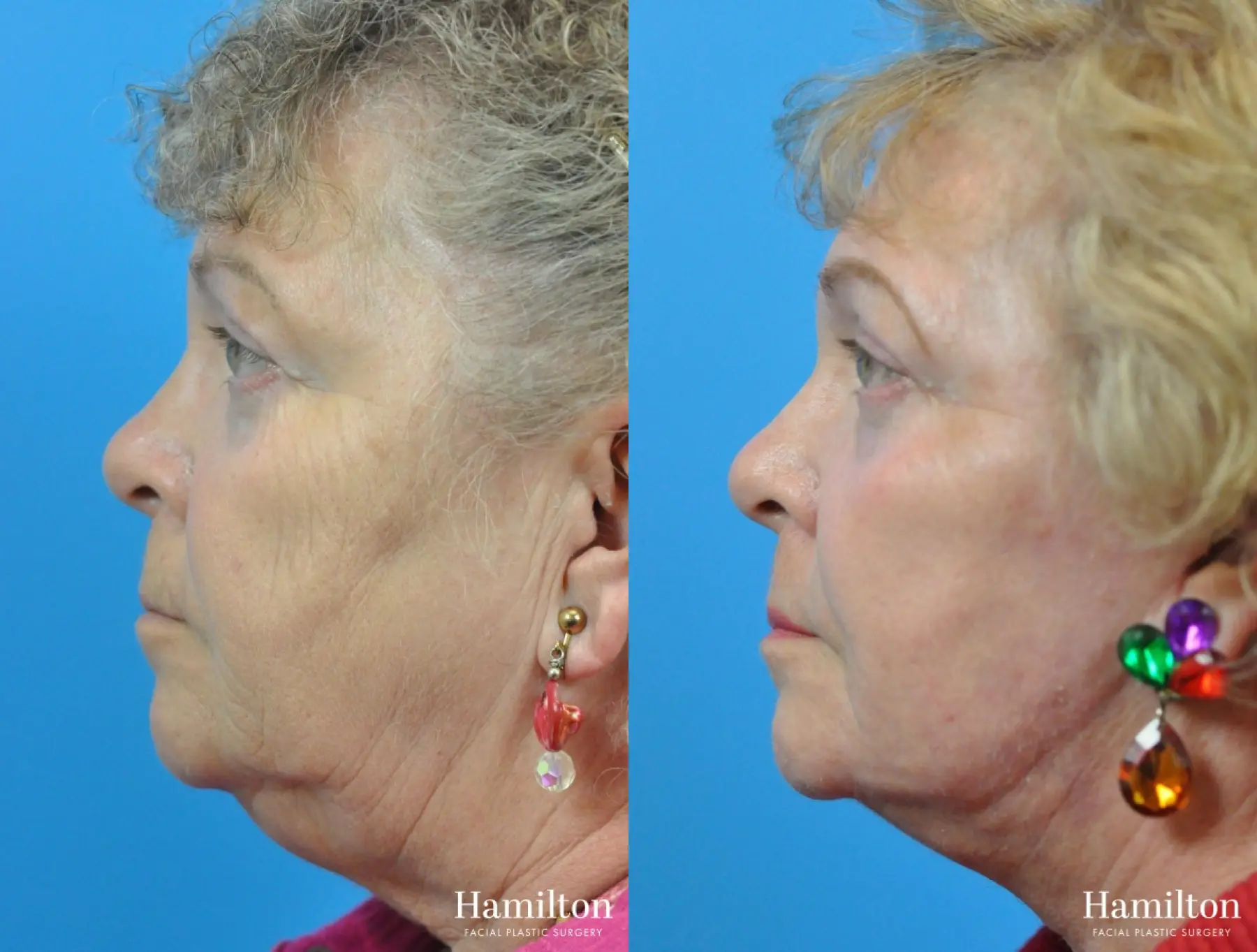 C02 Laser: Patient 10 - Before and After 2