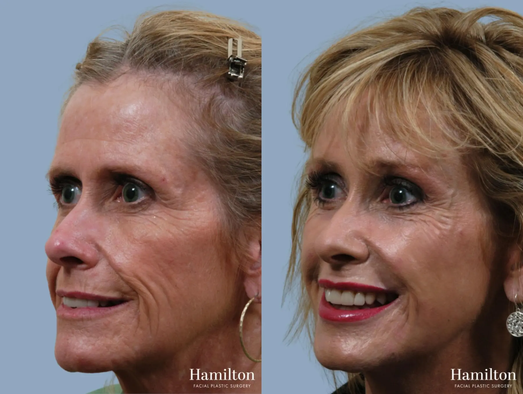 C02 Laser: Patient 9 - Before and After 2