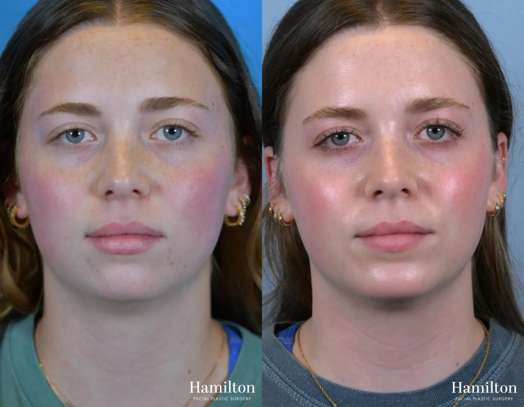 Chin Augmentation: Patient 4 - Before and After 2