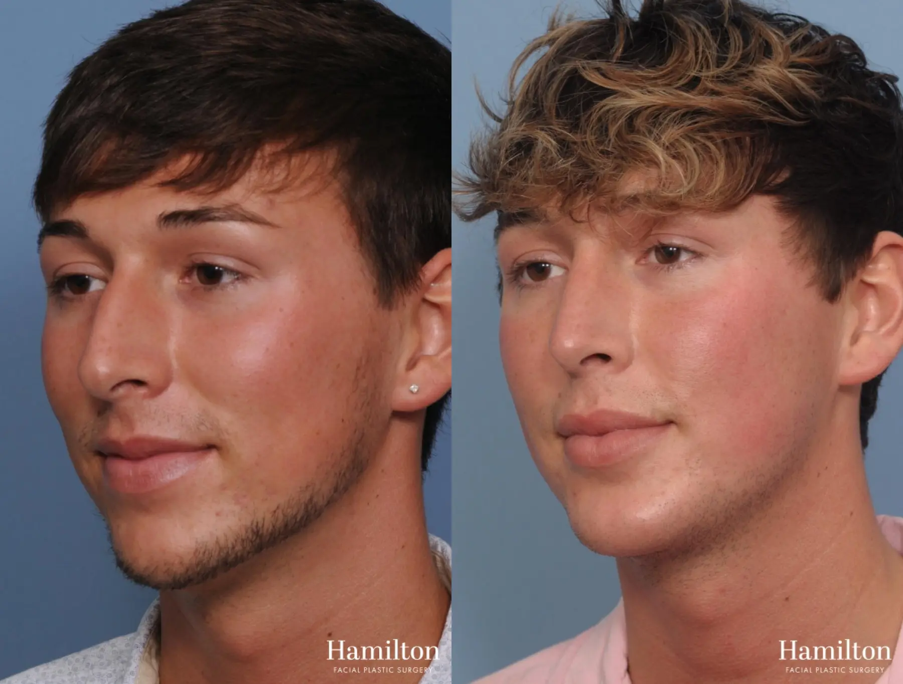 Chin Augmentation: Patient 2 - Before and After 3