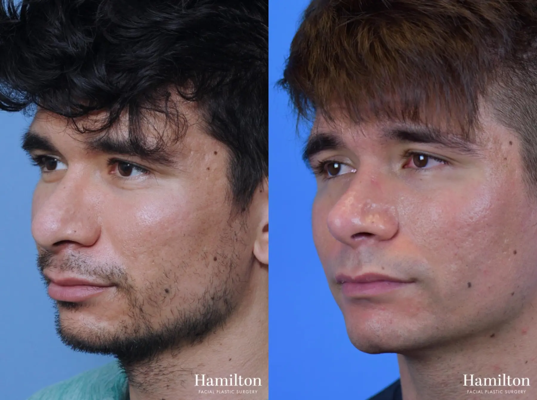 Chin Augmentation: Patient 7 - Before and After 5