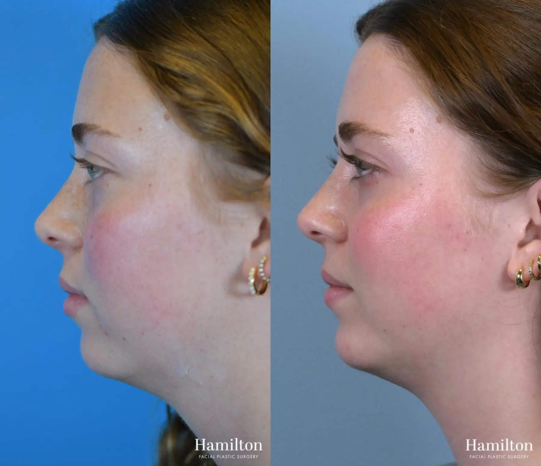 Chin Augmentation: Patient 4 - Before and After 4