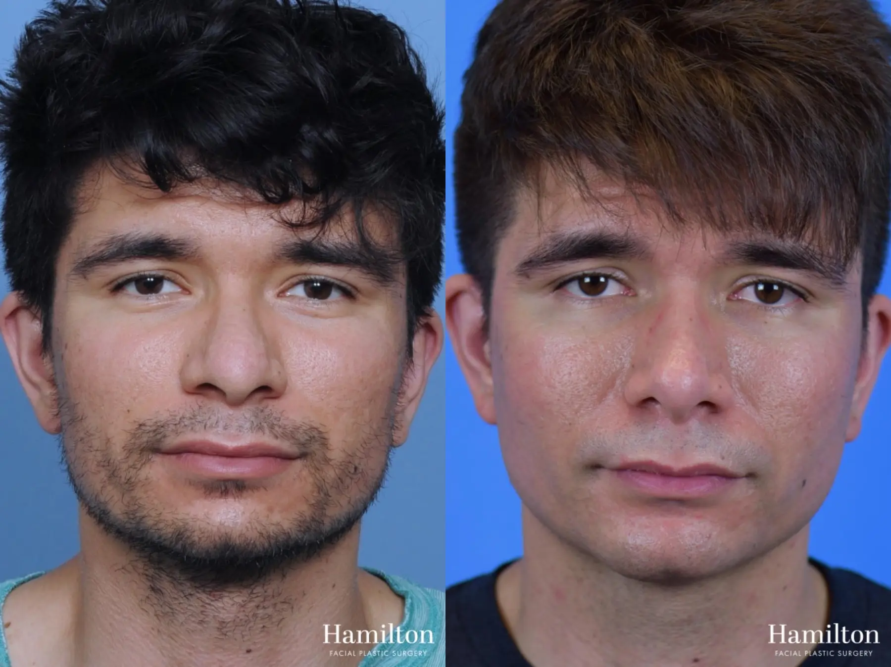 Chin Augmentation: Patient 7 - Before and After 3