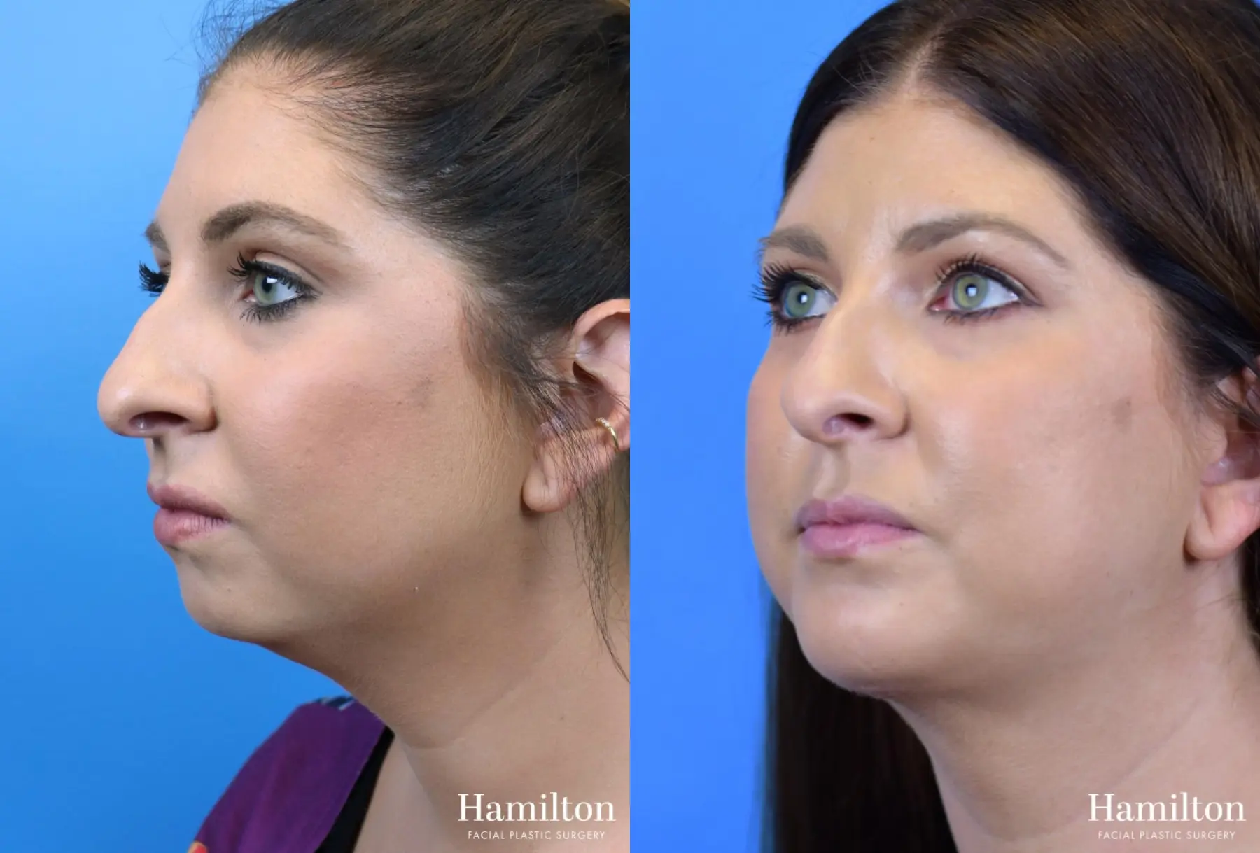 Chin Augmentation: Patient 9 - Before and After 2