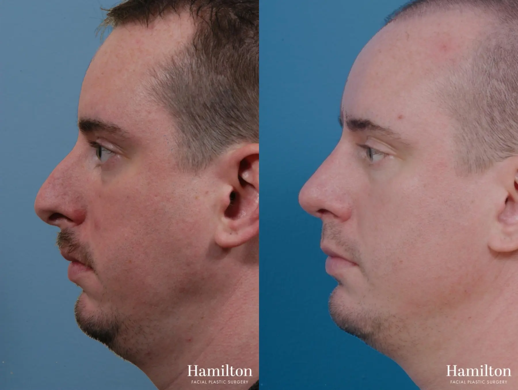 Chin Augmentation: Patient 8 - Before and After  