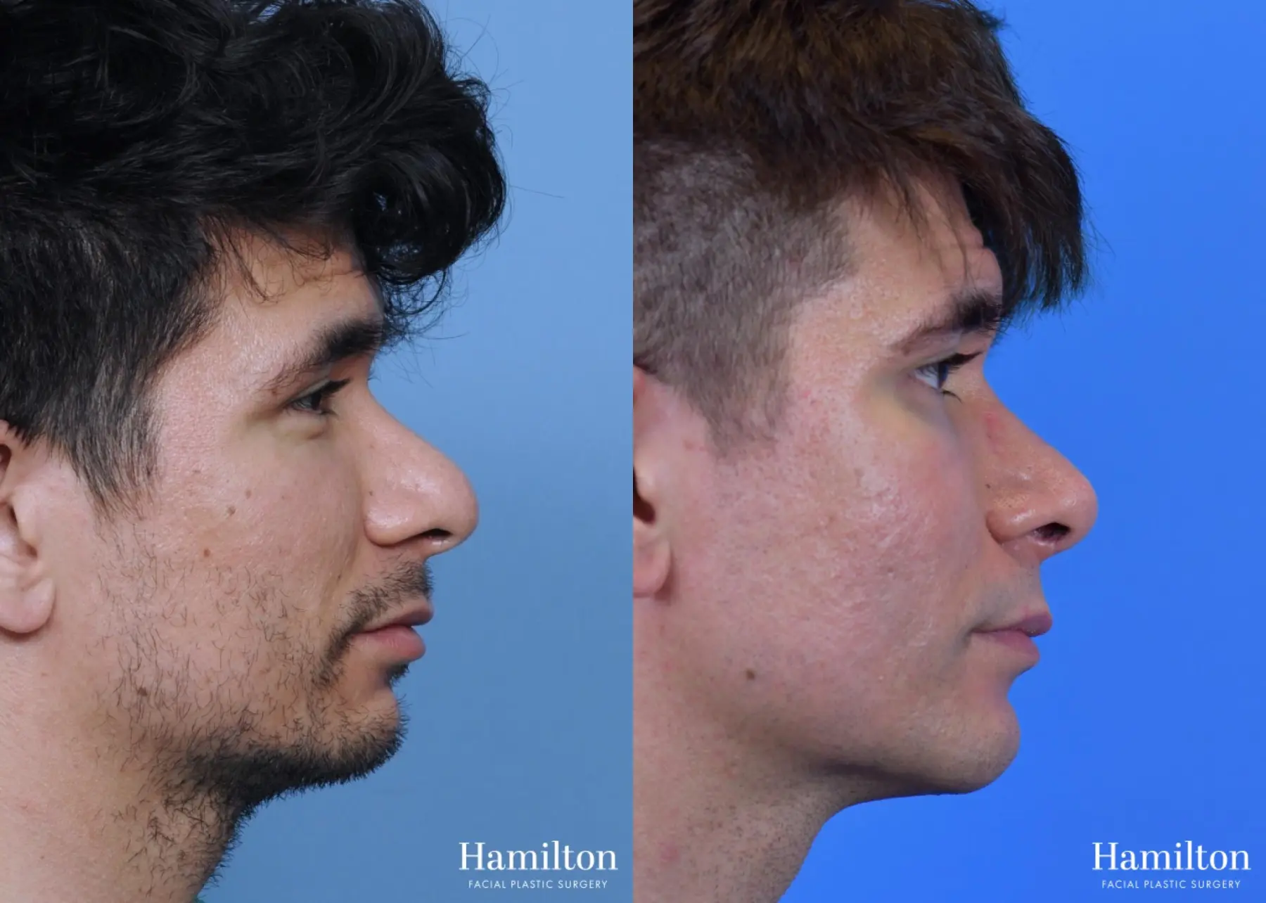 Chin Augmentation: Patient 7 - Before and After  