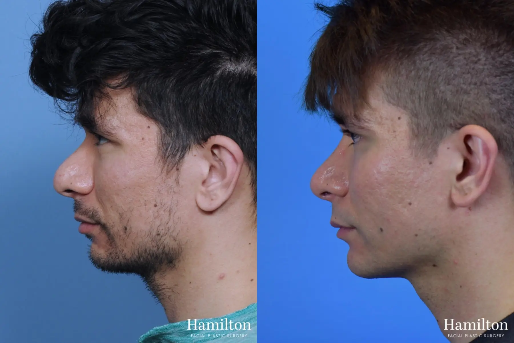 Chin Augmentation: Patient 7 - Before and After 2