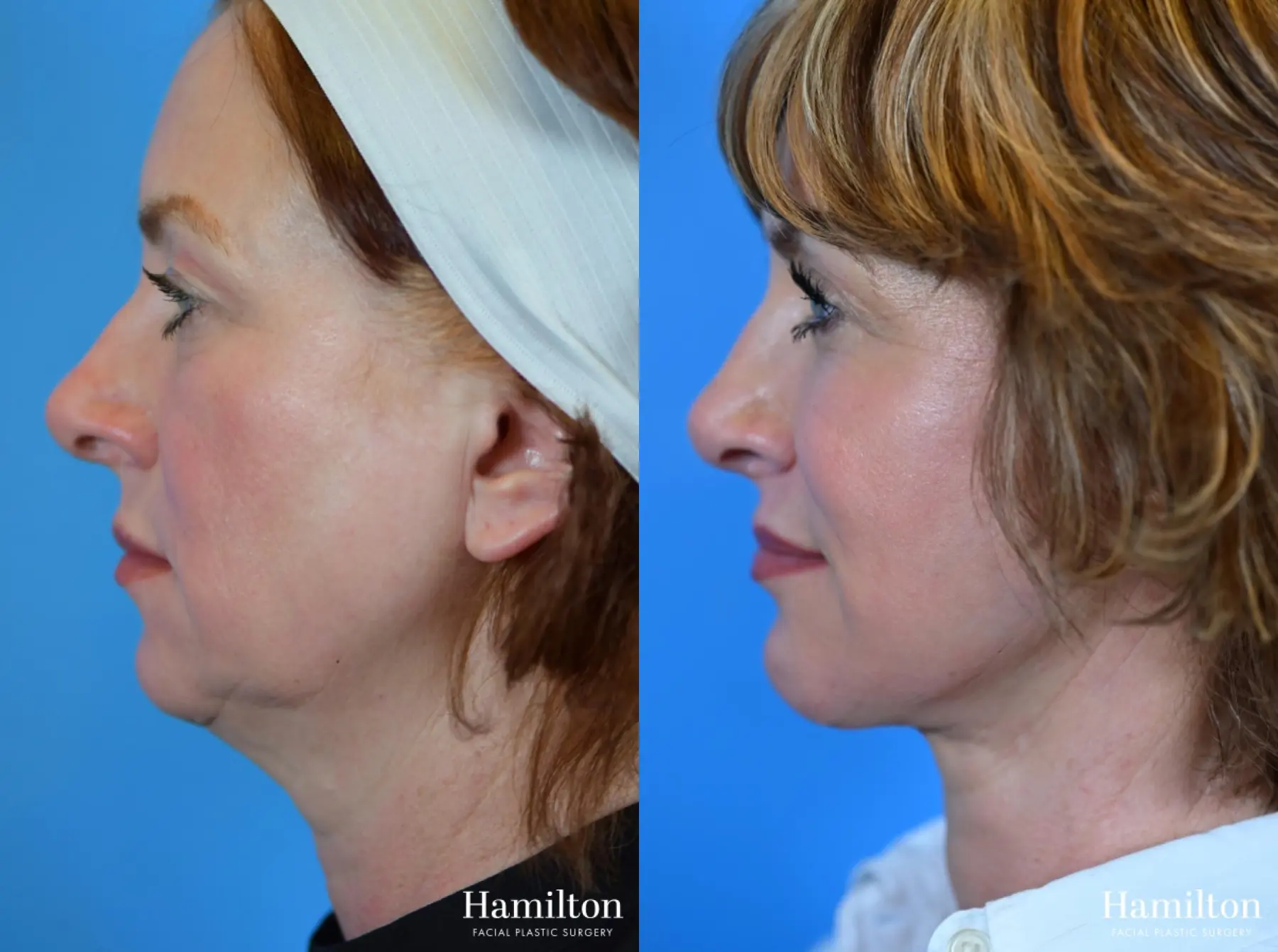 Chin Augmentation: Patient 3 - Before and After  