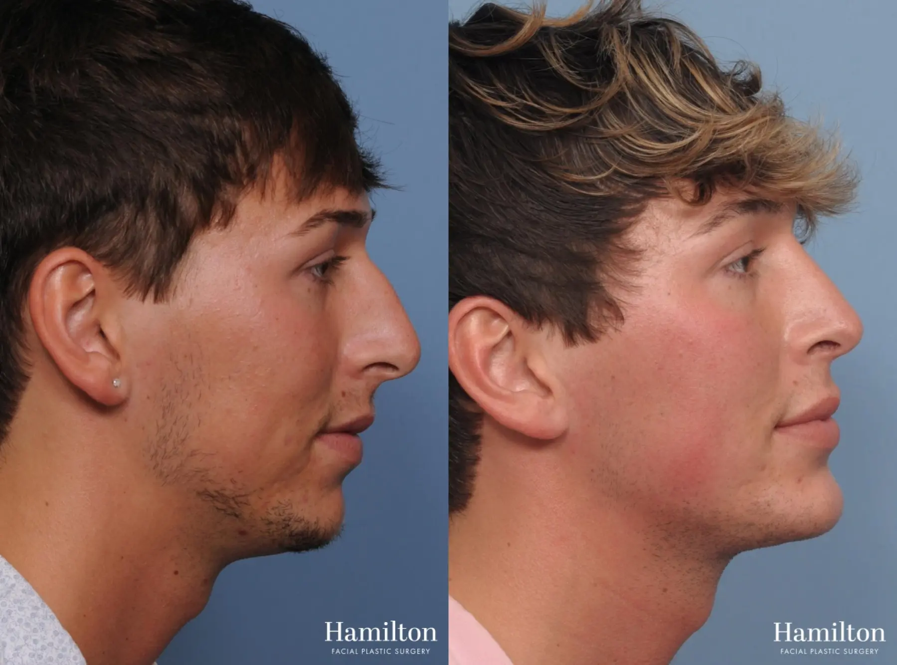 Chin Augmentation: Patient 2 - Before and After 2