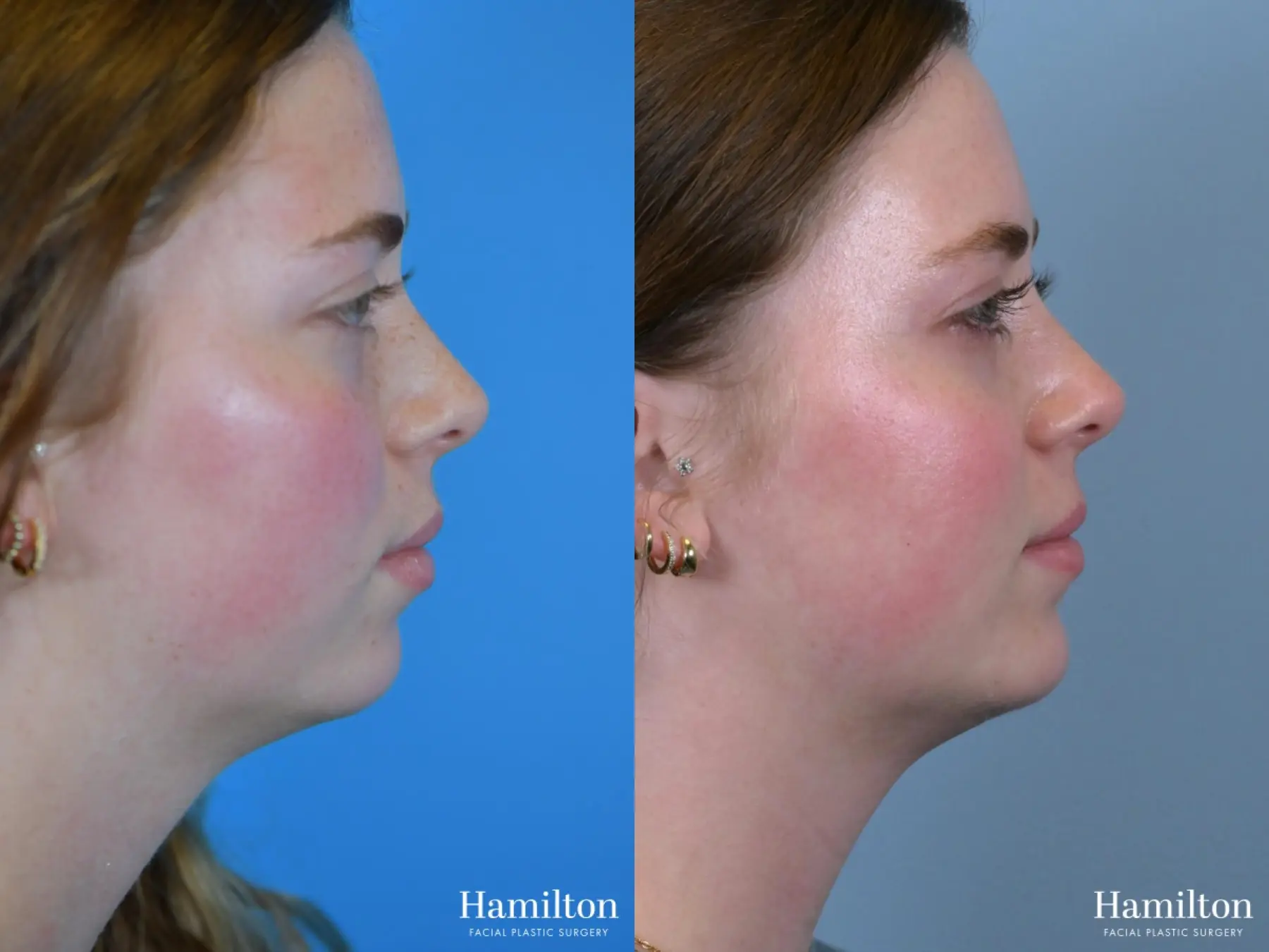 Chin Augmentation: Patient 4 - Before and After 3