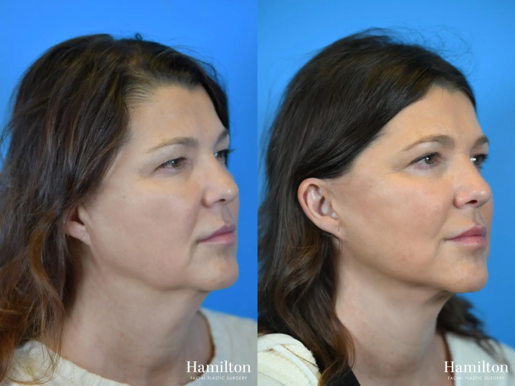 Facelift: Patient 10 - Before and After 2