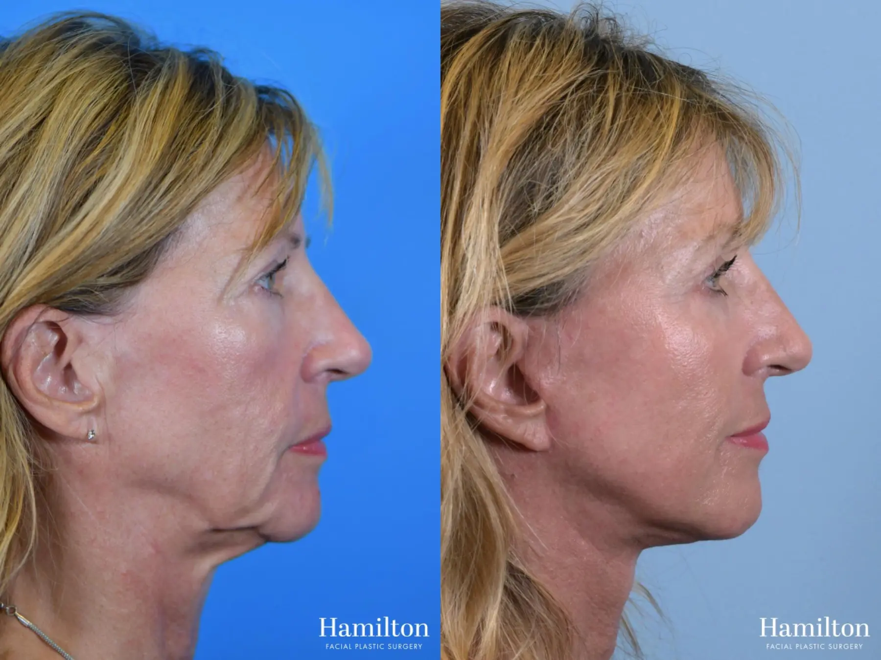 Facelift: Patient 17 - Before and After 2